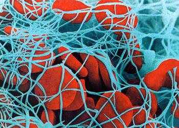 Свёртывание крови. На фотографии, выполненной электронным микроскопом, хорошо заметны эритроциты, застрявшие в нитях фибрина